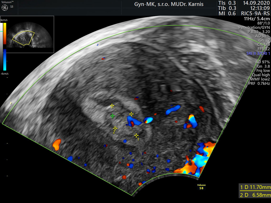 Polyp endometria aj s cievnou stopkou tzv. Pedicle artery sign