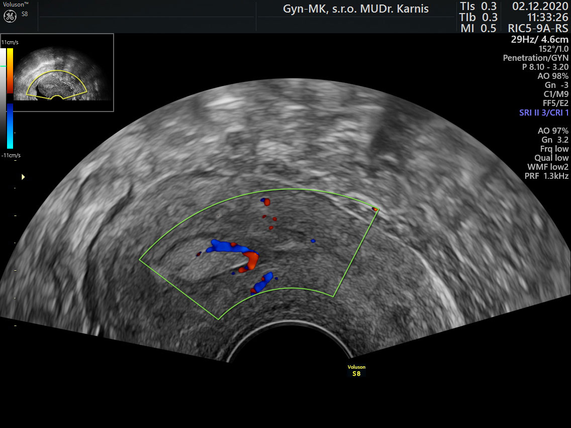 Polyp s cievnou stopkou endometria tzv. Pedicle artery sign