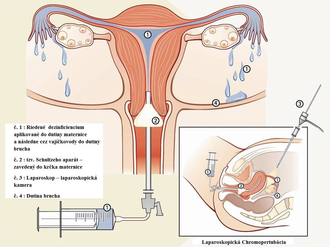 diagnostika zistenia priechodnosti vajíčkovodov pomocou Laparoskopie – tzv. Chromopertubácia