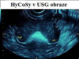 Viditeľný prietok USG kontrastného gélu vajíčkovodmi pri HyFoSy