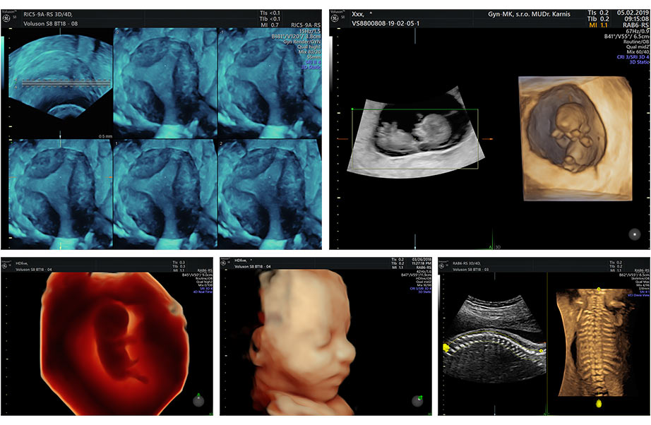 3D a 4D ultrazvuk